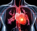 Double whammy: Stroke and neck artery tear increase heart attack risk in the first year