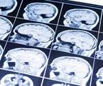 World's largest brain study reveals how childhood trauma rewires vital neural pathways